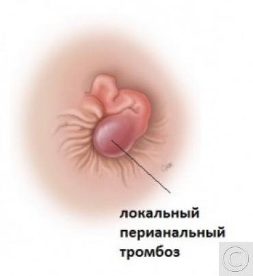 Лечение геморроя 4 стадии в медицинском центре «Я здоров», цены в Новосибирске